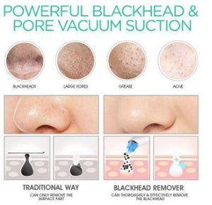 Pore Vacuum Blackhead Remover